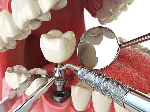 Best Emergency Treatment for Dental Infections or Abscesses in Pleasanton, KS